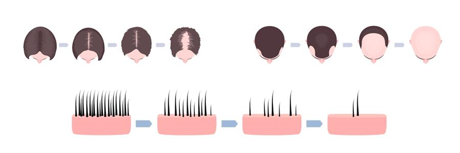 sac dokulmesi ve nedenleri hdc protez sac merkezi turkiye nin ilk protez sac merkezi