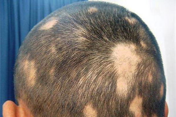 Pelat (Saç Kıran) Hastalığı İçin Protez Saç Çözümleri