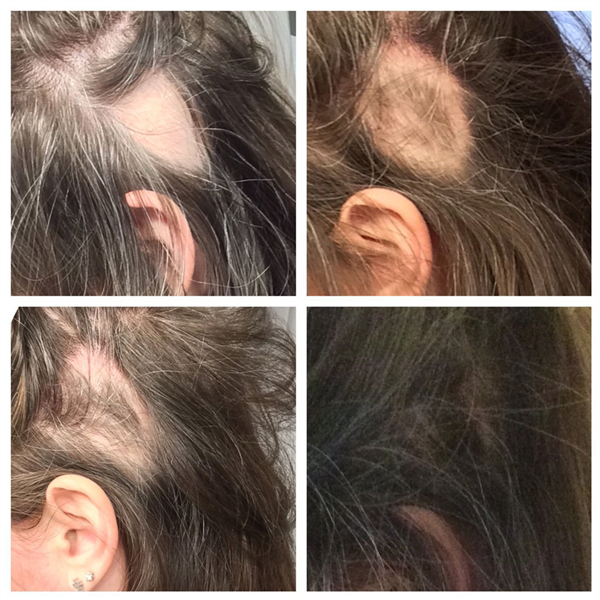 Alopesi Areata Sac Kiran Icin Protez Sac Cozumleri Hdc Protez Sac Merkezi Turkiye Nin Ilk Protez Sac Merkezi