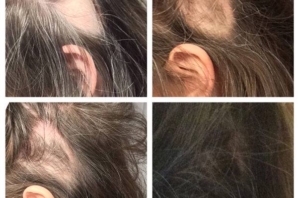 Alopesi Areata (Saç Kıran) İçin Protez Saç Çözümleri