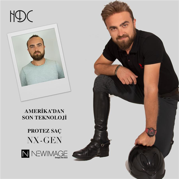 Protez Sac Nedir Hdc Protez Sac Merkezi Turkiye Nin Ilk Protez Sac Merkezi