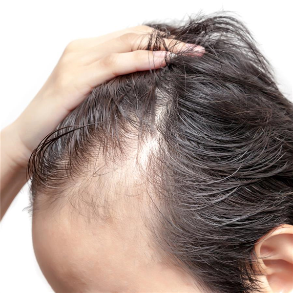 seyrek saclara yepyeni bir cozum hdc protez sac merkezi turkiye nin ilk protez sac merkezi